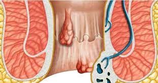 पाइल्स : राम्रोसँग उपचार नभए हुनसक्छ क्यान्सर