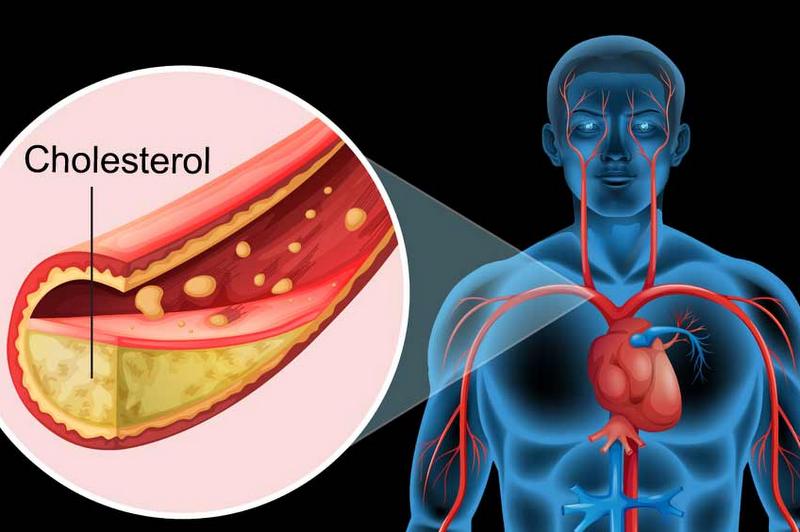 उच्च कोलेस्ट्रोलका कारण र नियन्त्रण गर्ने उपाय 