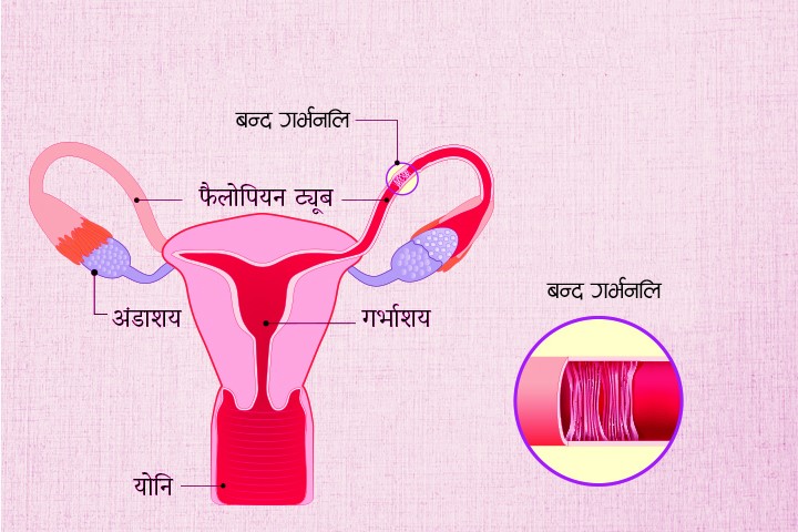 गर्भनलि बन्द हुनुको कारण र उपचार