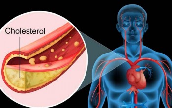 उच्च कोलेस्ट्रोलका कारण र नियन्त्रण गर्ने उपाय 