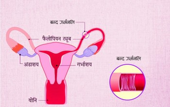 गर्भनलि बन्द हुनुको कारण र उपचार