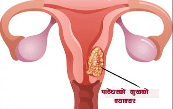 इलाममै हुने भयो पाठेघरको मुखको क्यान्सरको उपचार