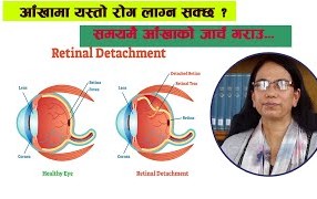 रेटिनल डिट्याचमेन्ट (आँखाको पर्दा उक्किने) समस्या के हो ? कारण, लक्षण र उपचार