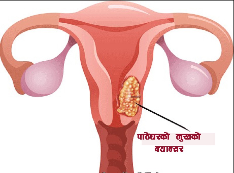 टीकापुरमा पाठेघरको मुखको क्यान्सर परीक्षण शिविर