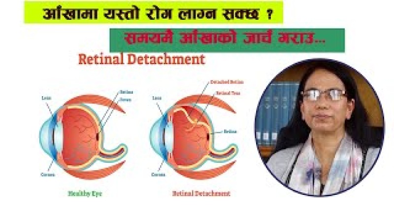 रेटिनल डिट्याचमेन्ट (आँखाको पर्दा उक्किने) समस्या के हो ? कारण, लक्षण र उपचार