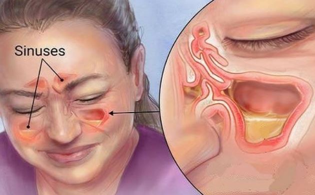 किन हुन्छ पिनास ? यसका लक्षण र बच्ने उपाय