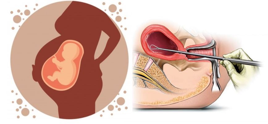 गण्डकी प्रदेशमा गर्भपतनको विकराल रुप, वार्षिक १२ हजारले गराए गर्भपतन 