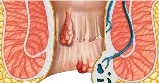 पाइल्स : राम्रोसँग उपचार नभए हुनसक्छ क्यान्सर